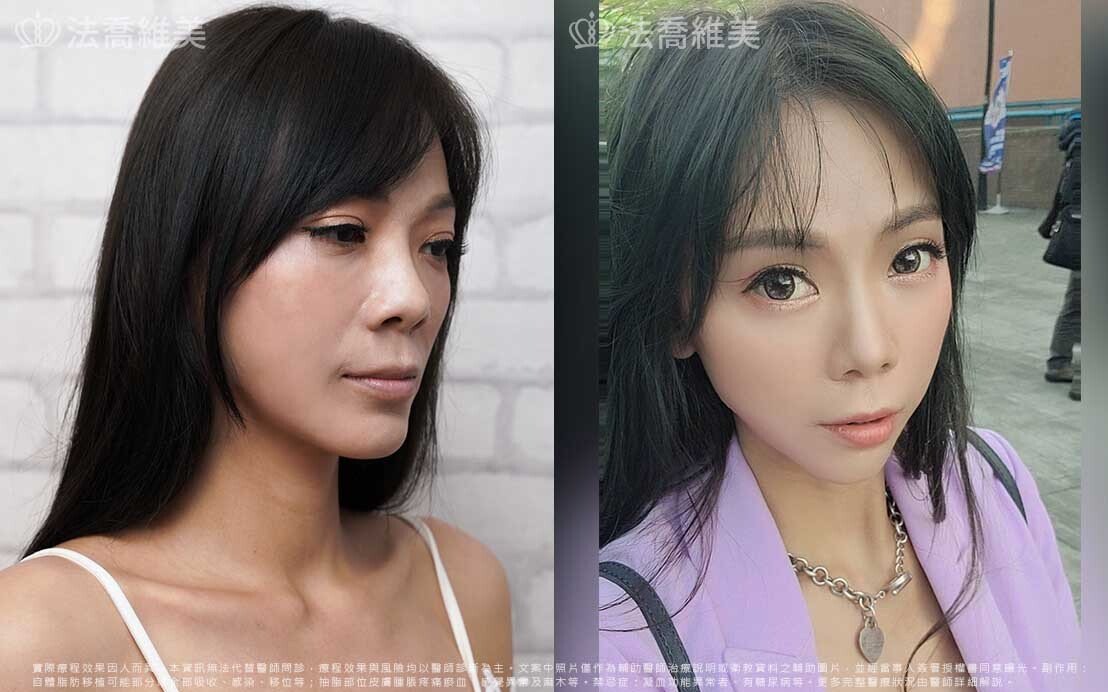 補脂