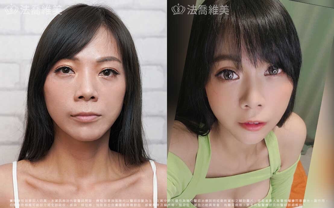 自體脂肪豐臉