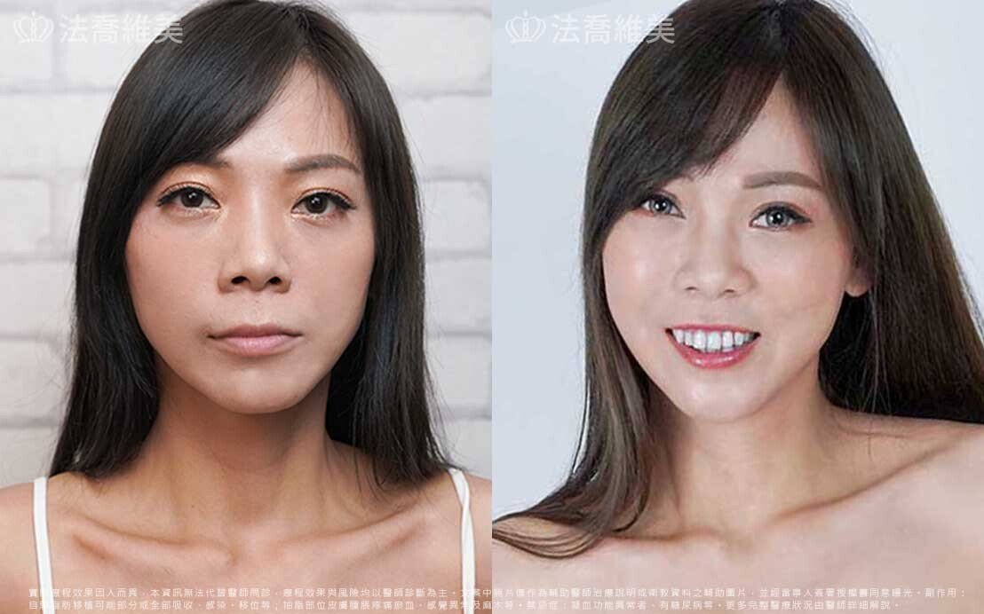 隆鼻推薦