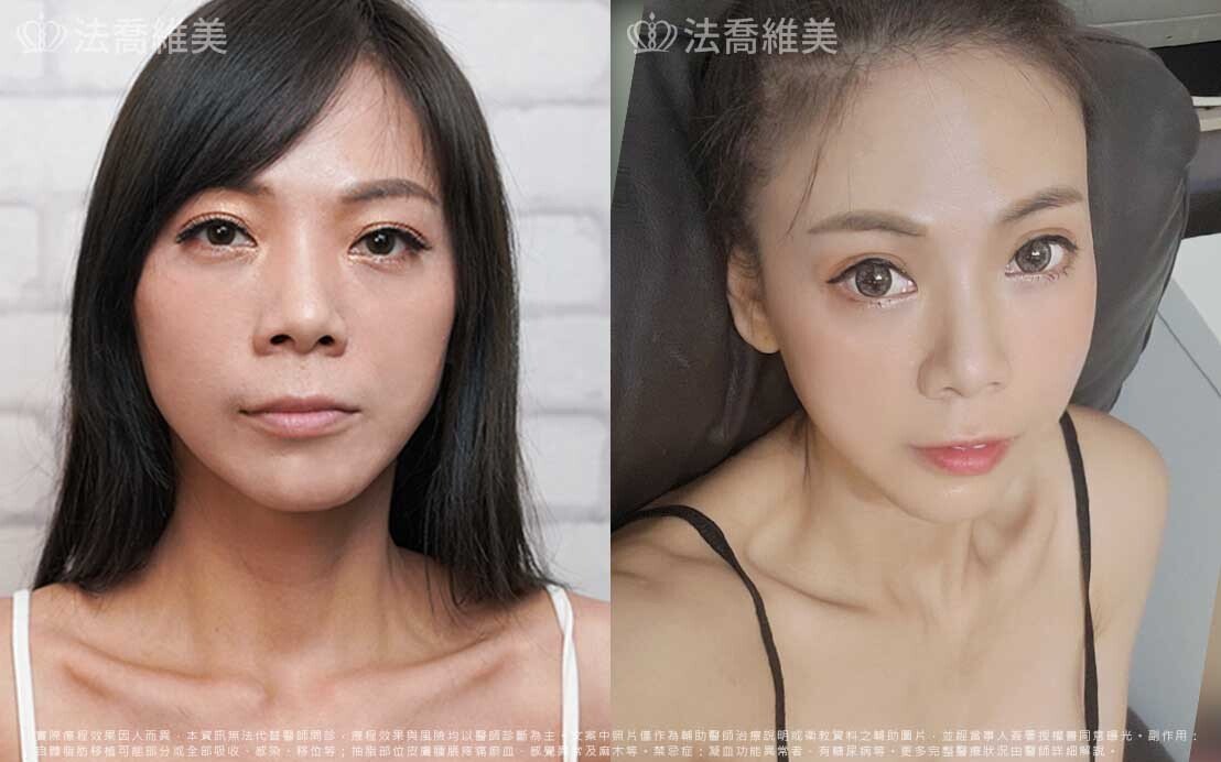 脂肪豐臉
