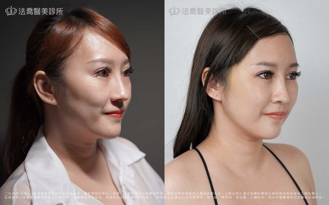 豐臉