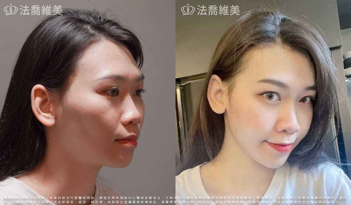 平平自體脂肪豐臉(術後3個月)2