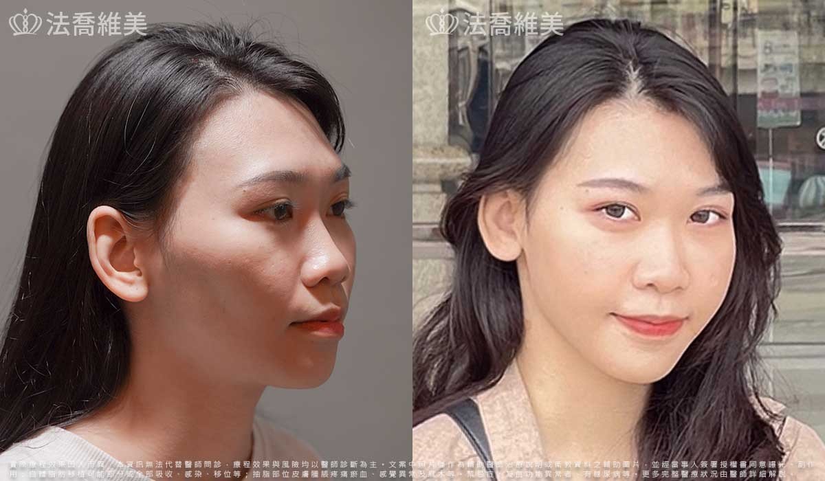 平平自體脂肪豐臉(術後1個月)2