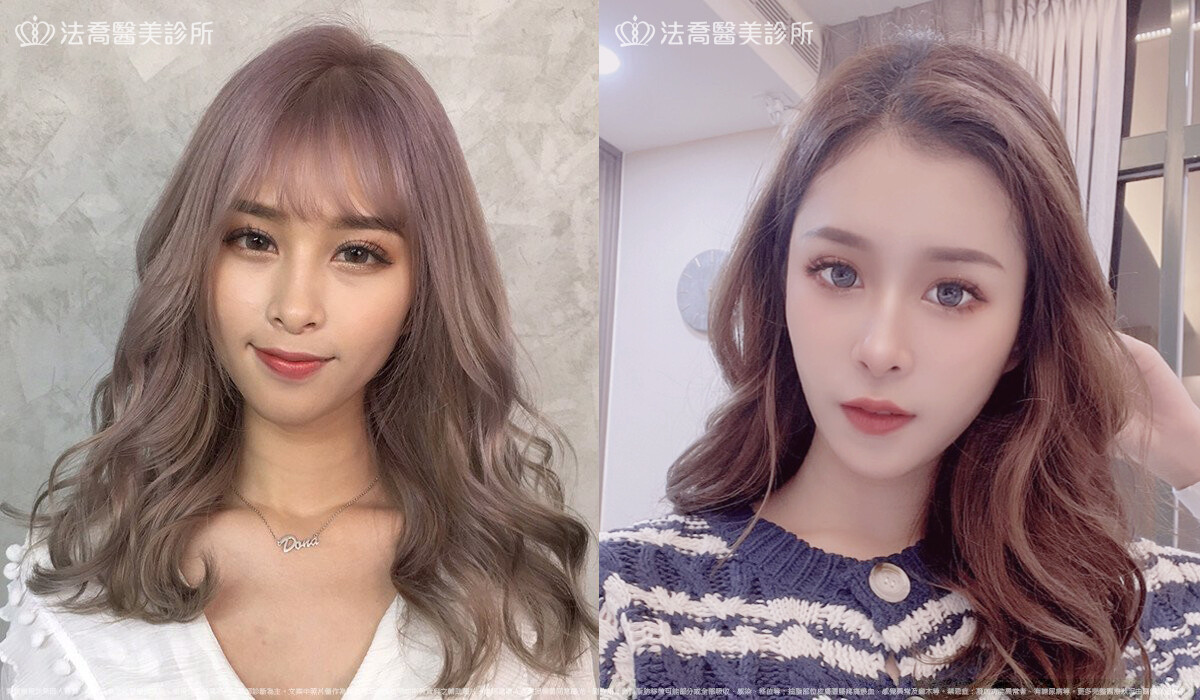 法喬醫美診所,邱浚彥,自體脂肪豐臉