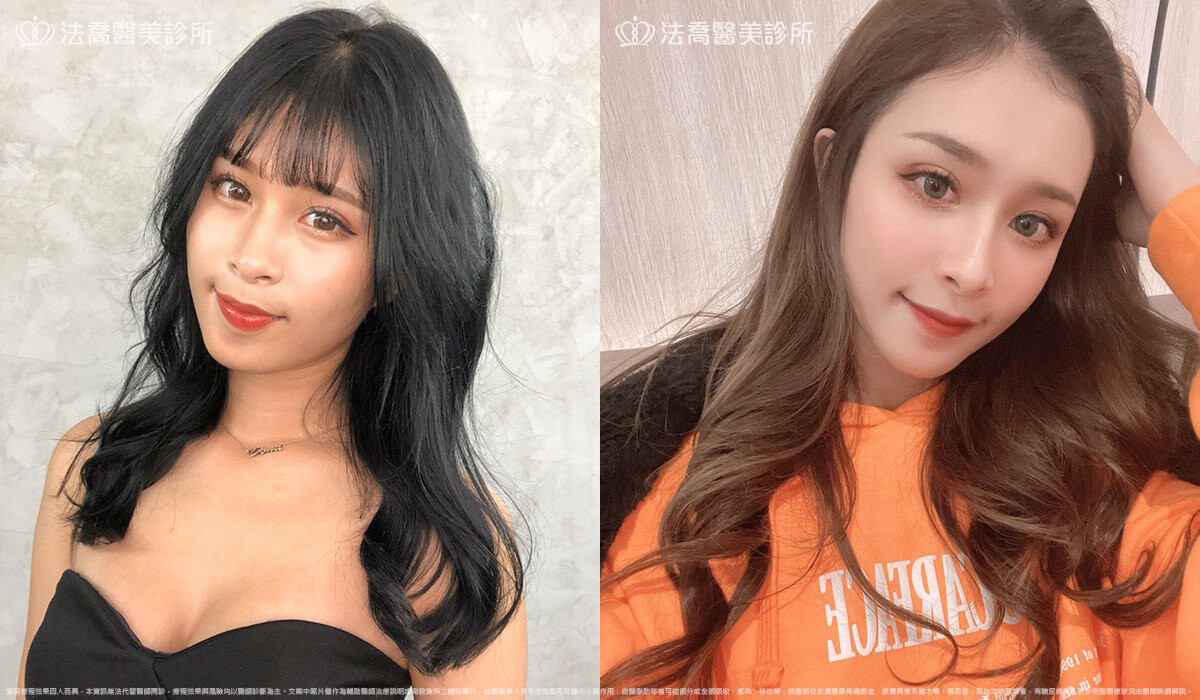 法喬醫美診所,邱浚彥,自體脂肪豐臉