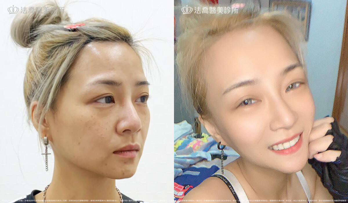 PICOCARE 皮秒雷射 術後1個月