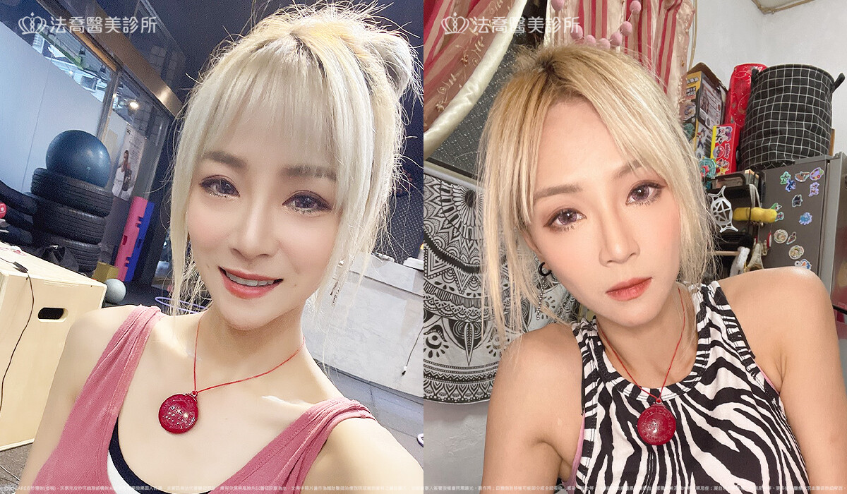 皮秒雷射 術後生活照