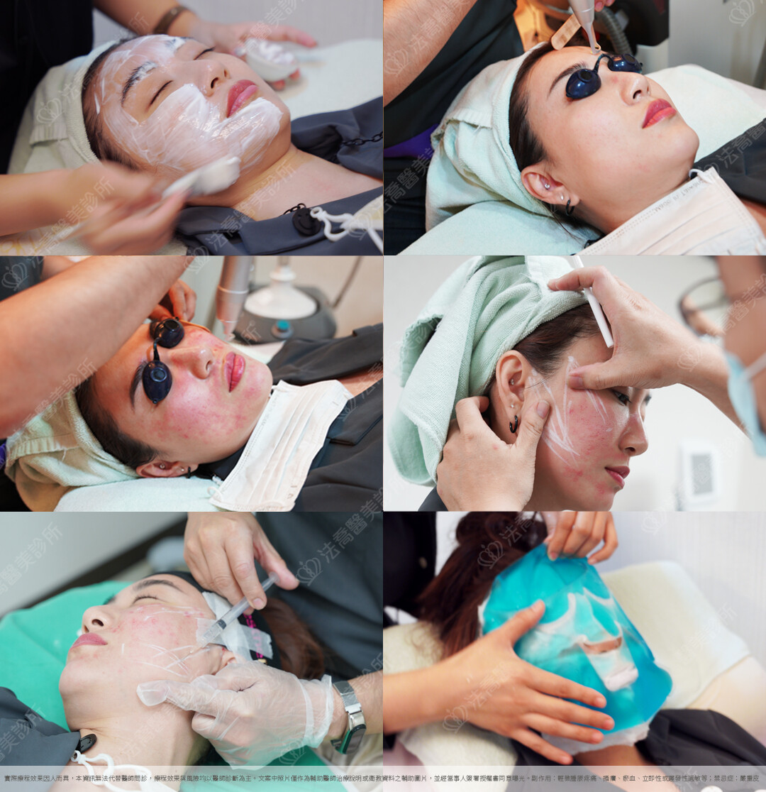 PICOCARE 皮秒雷射/埋線過程