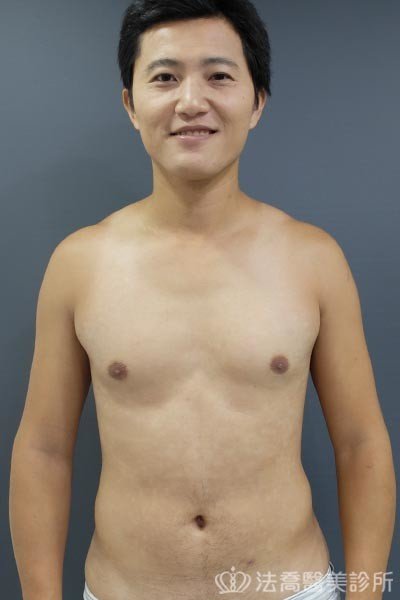 法喬威塑腹部環抽雕塑術後案例