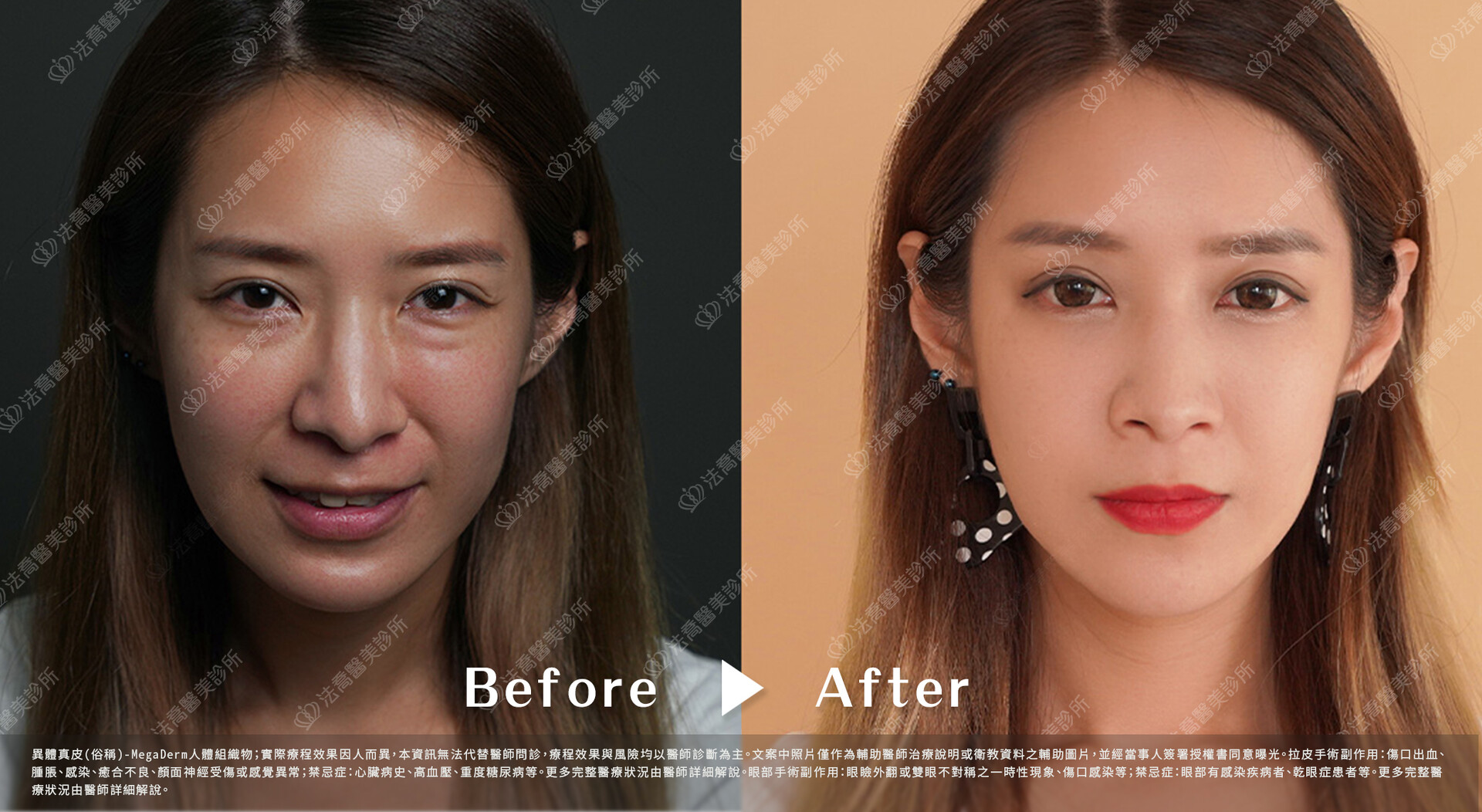 異體真皮鼻唇溝(法令)填補術 術前與術後3個月