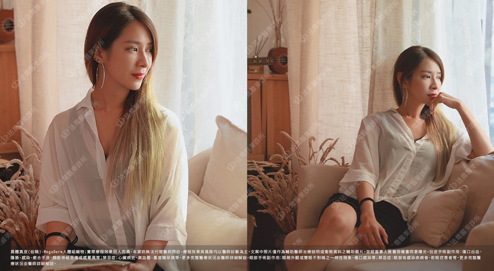 眼袋內開、脂肪移位 術後4個月