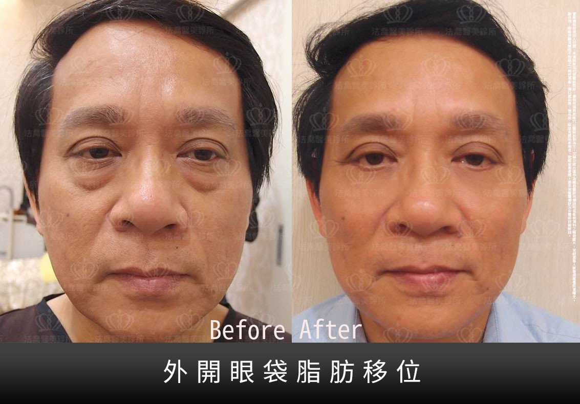 邱浚彥,法喬醫美診所,眼袋外開