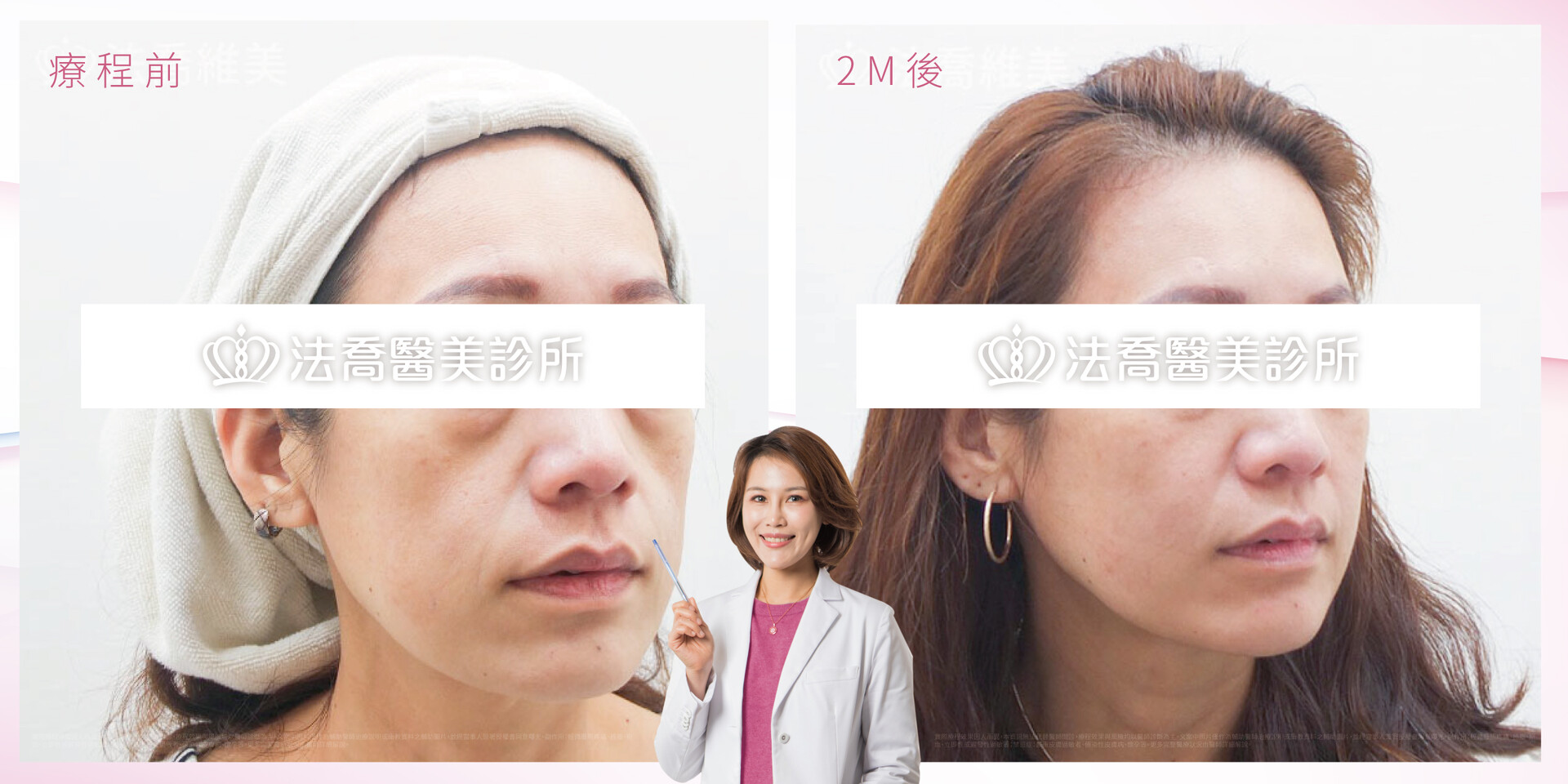 台中艾麗斯價格多少張慈恩醫師案例