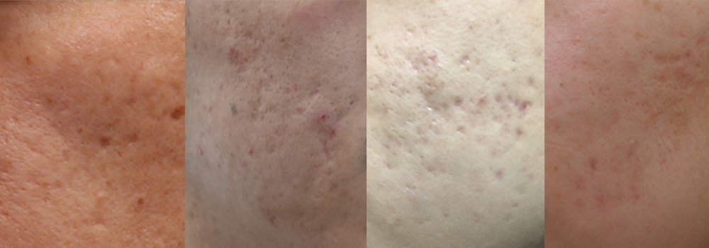 雷射除斑,淨膚雷射前後圖