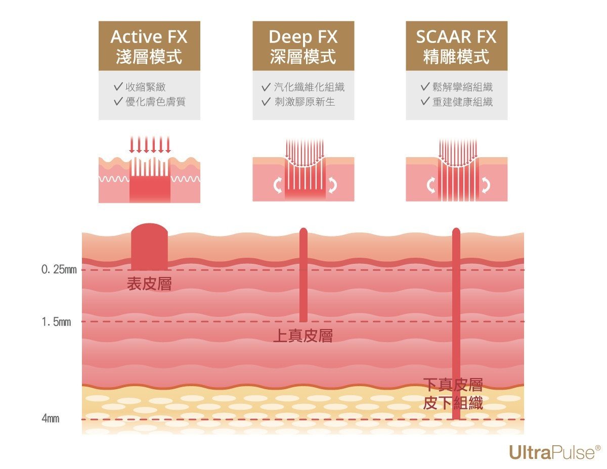 UP雷射三種模式