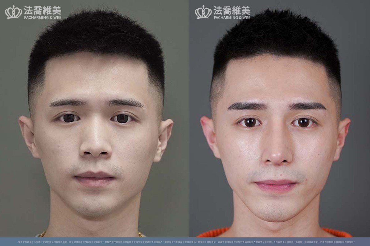 自體肋骨隆鼻案例