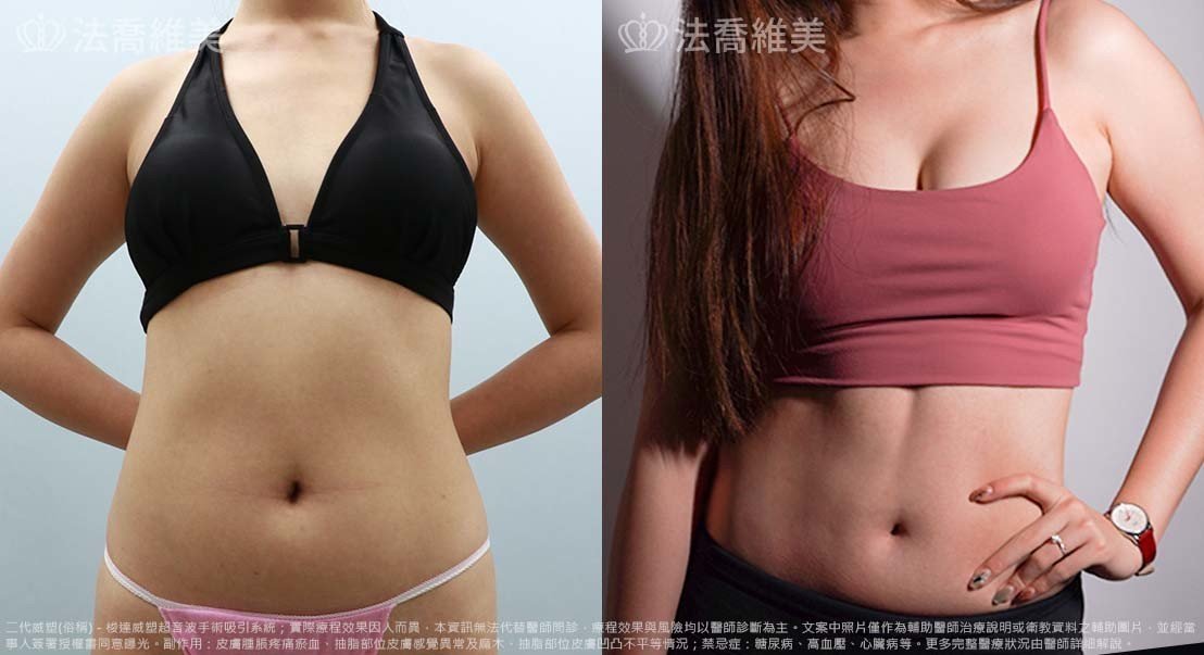 法喬醫美診所邱浚彥醫師威塑抽脂體雕